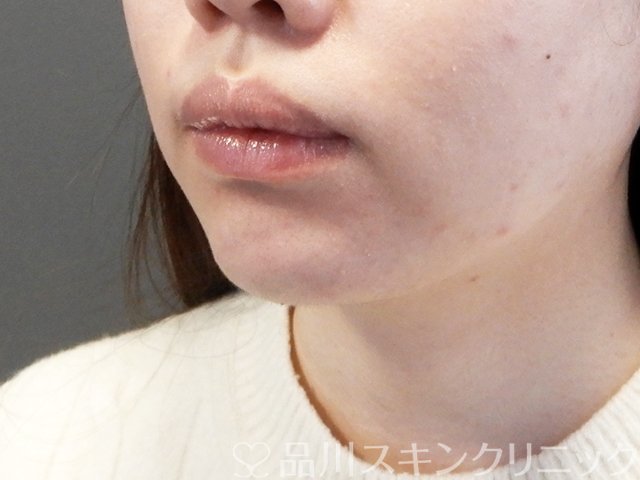 症例NO.67998のAFTER写真