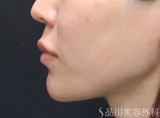 症例NO.74949のAFTER写真