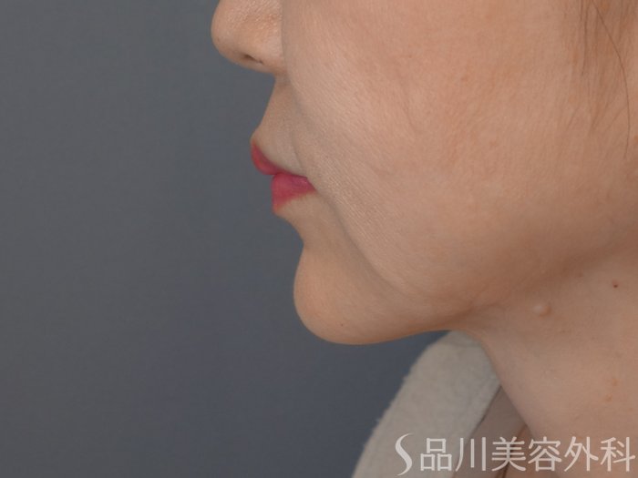 症例NO.71582のAFTER写真