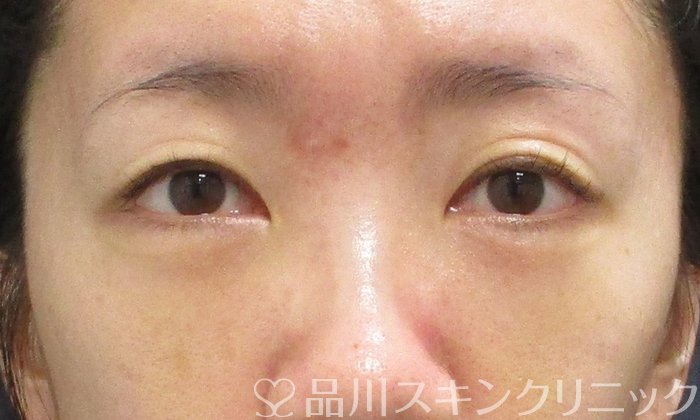 症例NO.68717のAFTER写真