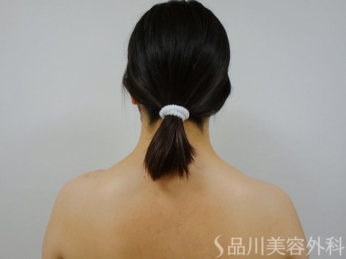 症例NO.73279のAFTER写真