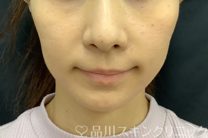 症例NO.69842のBEFORE写真