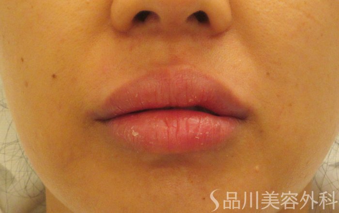 症例NO.70844のAFTER写真