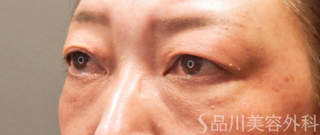 症例NO.69997のBEFORE写真