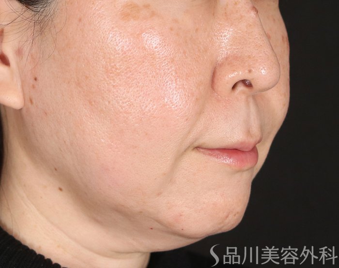 症例NO.72498のAFTER写真