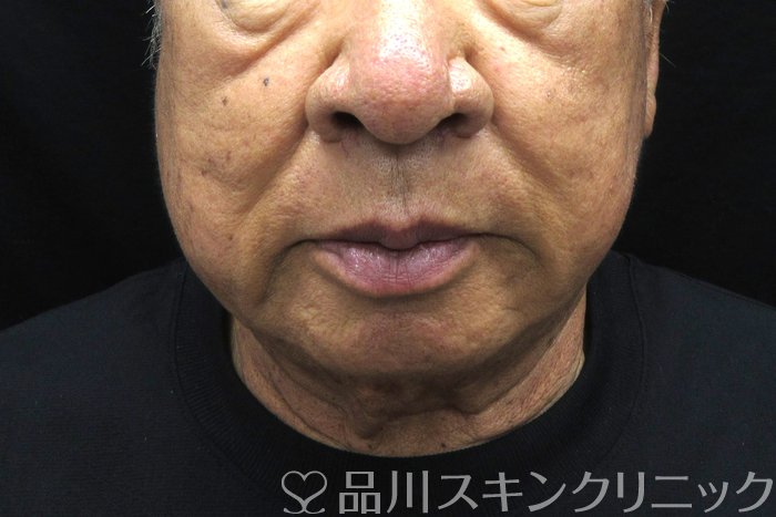 症例NO.74884のBEFORE写真