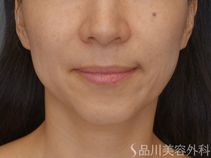 症例NO.72044のBEFORE写真
