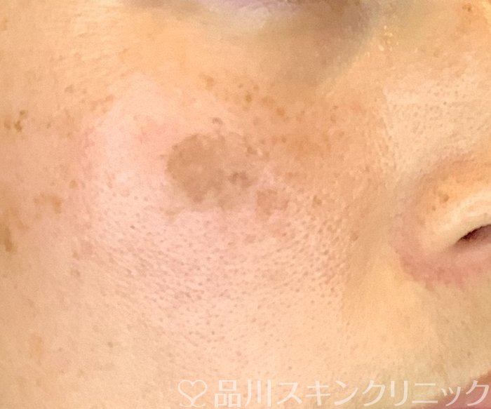 症例NO.65111のBEFORE写真