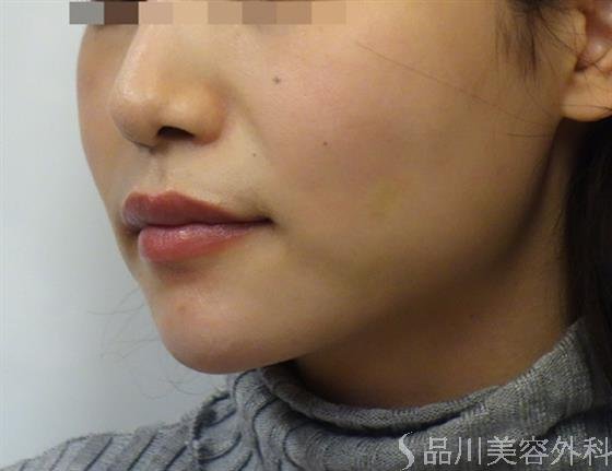 症例NO.39986のBEFORE写真