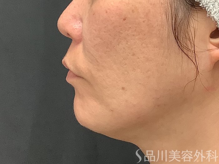 症例NO.67791のAFTER写真