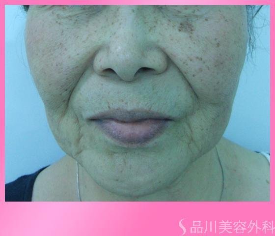 症例NO.2599のBEFORE写真