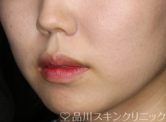 症例NO.73086のBEFORE写真