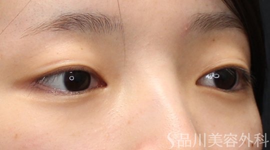 症例NO.74902のBEFORE写真