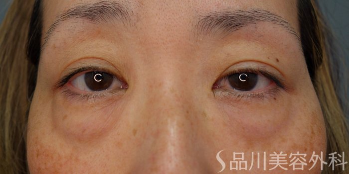 症例NO.74407のBEFORE写真