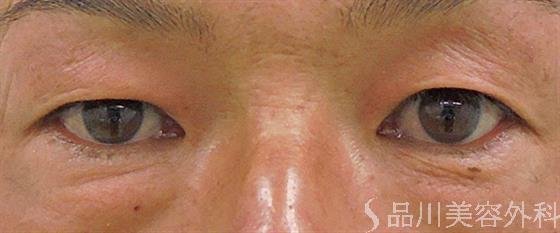 症例NO.46382のBEFORE写真