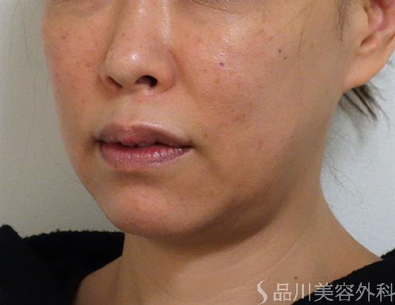 症例NO.40179のAFTER写真