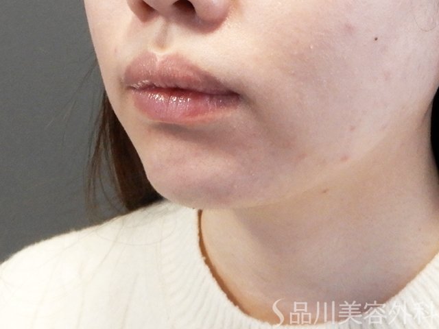 症例NO.67998のAFTER写真