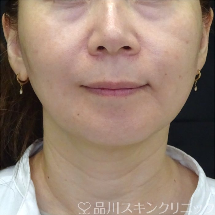 症例NO.71989のAFTER写真