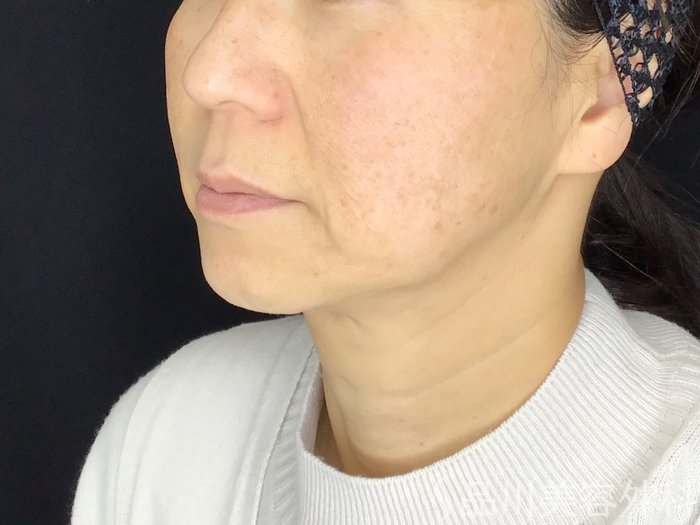 症例NO.69592のBEFORE写真