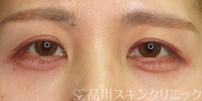症例NO.70361のAFTER写真