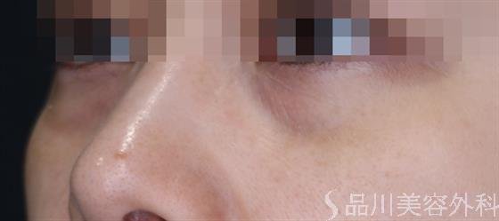 症例NO.61680のBEFORE写真