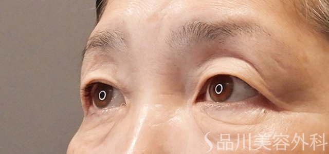 症例NO.72485のBEFORE写真