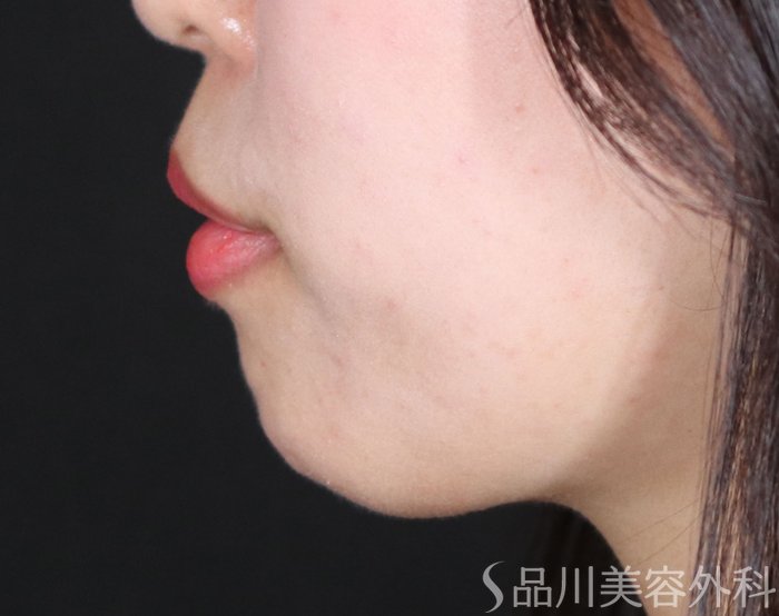 症例NO.72142のBEFORE写真