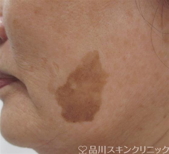 症例NO.42786のBEFORE写真
