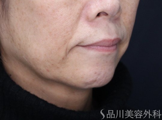 症例NO.72179のAFTER写真