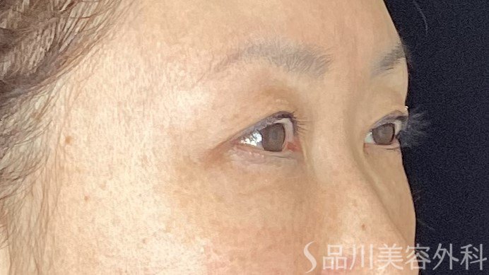 症例NO.67699のBEFORE写真