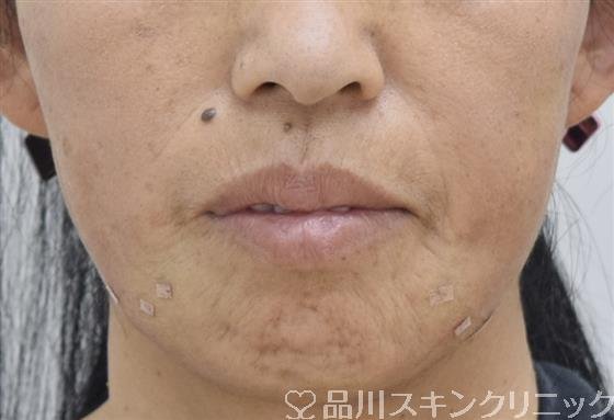 症例NO.43083のAFTER写真