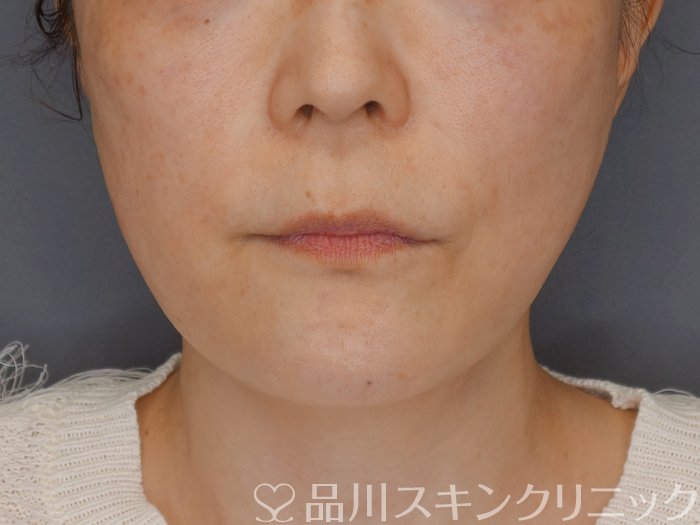 症例NO.72264のAFTER写真