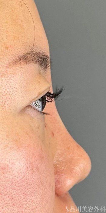 症例NO.73009のAFTER写真