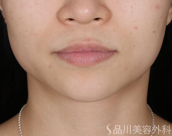 症例NO.72185のBEFORE写真