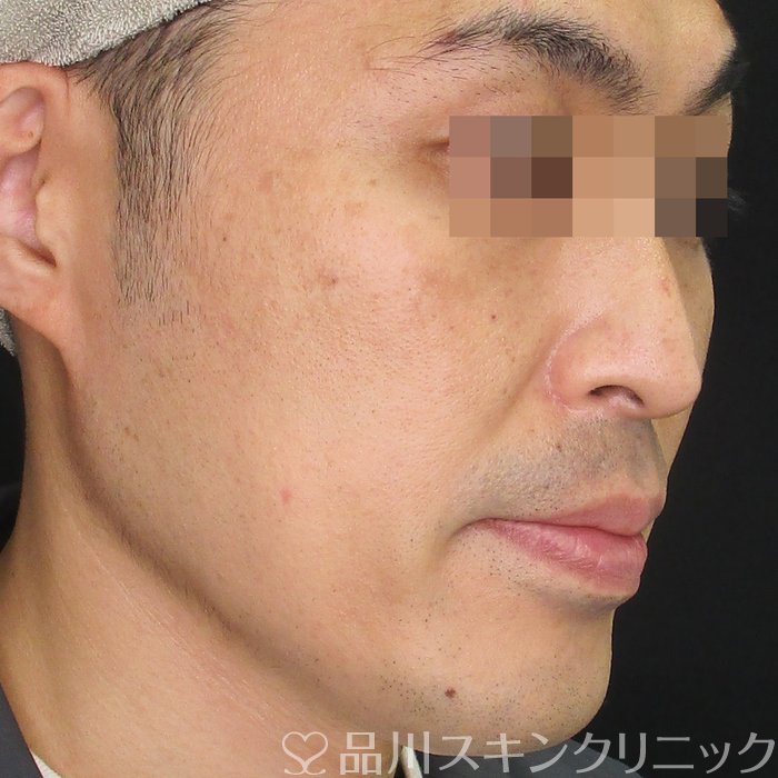 症例NO.70007のAFTER写真