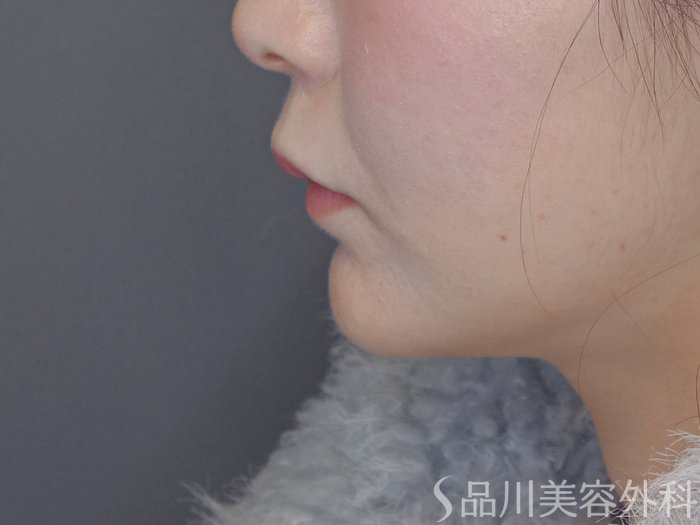 症例NO.72406のAFTER写真