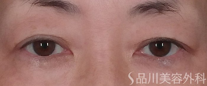 症例NO.70856のBEFORE写真