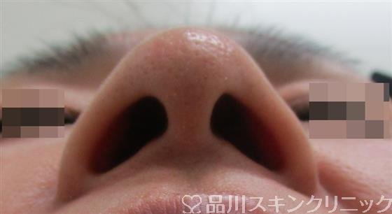 症例NO.29914のBEFORE写真