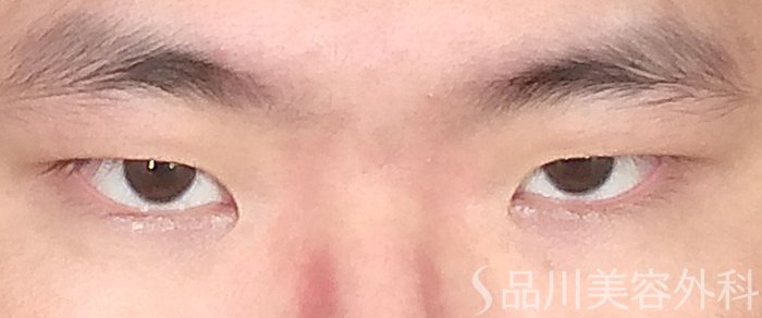 症例NO.64791のBEFORE写真