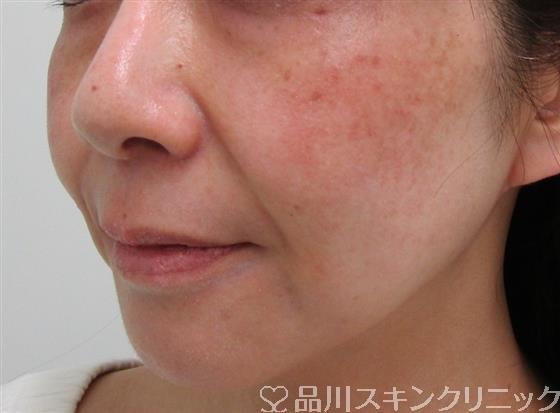 症例NO.34889のBEFORE写真