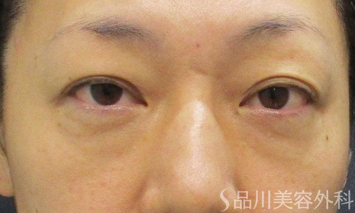症例NO.69580のBEFORE写真