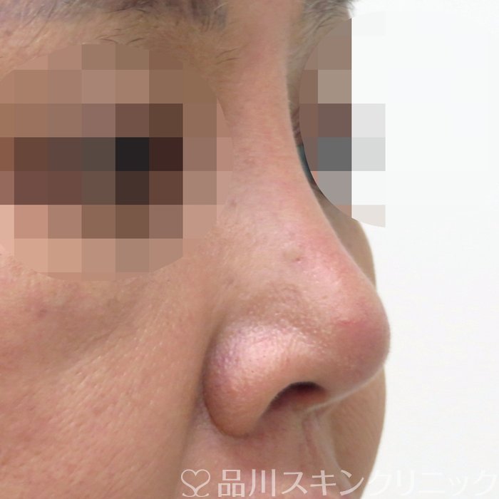 症例NO.70801のAFTER写真