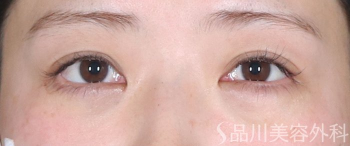 症例NO.72587のAFTER写真