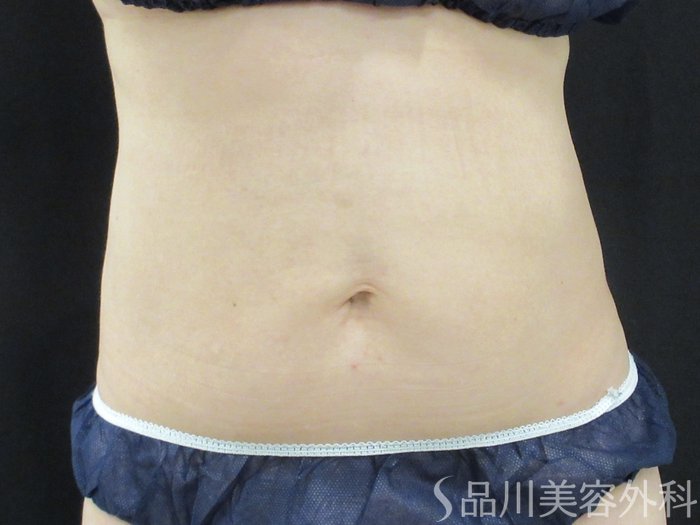 症例NO.75330のAFTER写真