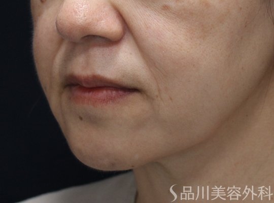 症例NO.74431のBEFORE写真