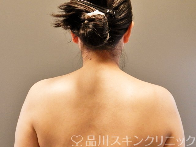 症例NO.62852のAFTER写真