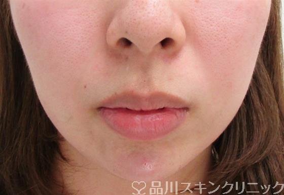症例NO.34789のAFTER写真