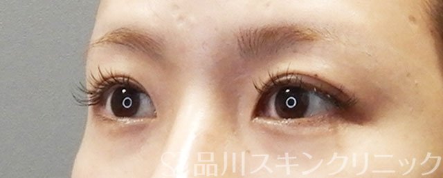 症例NO.72991のBEFORE写真