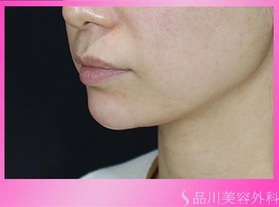 症例NO.49173のAFTER写真