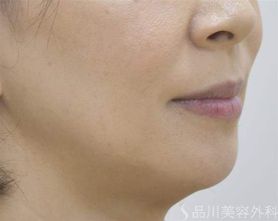 症例NO.45253のBEFORE写真